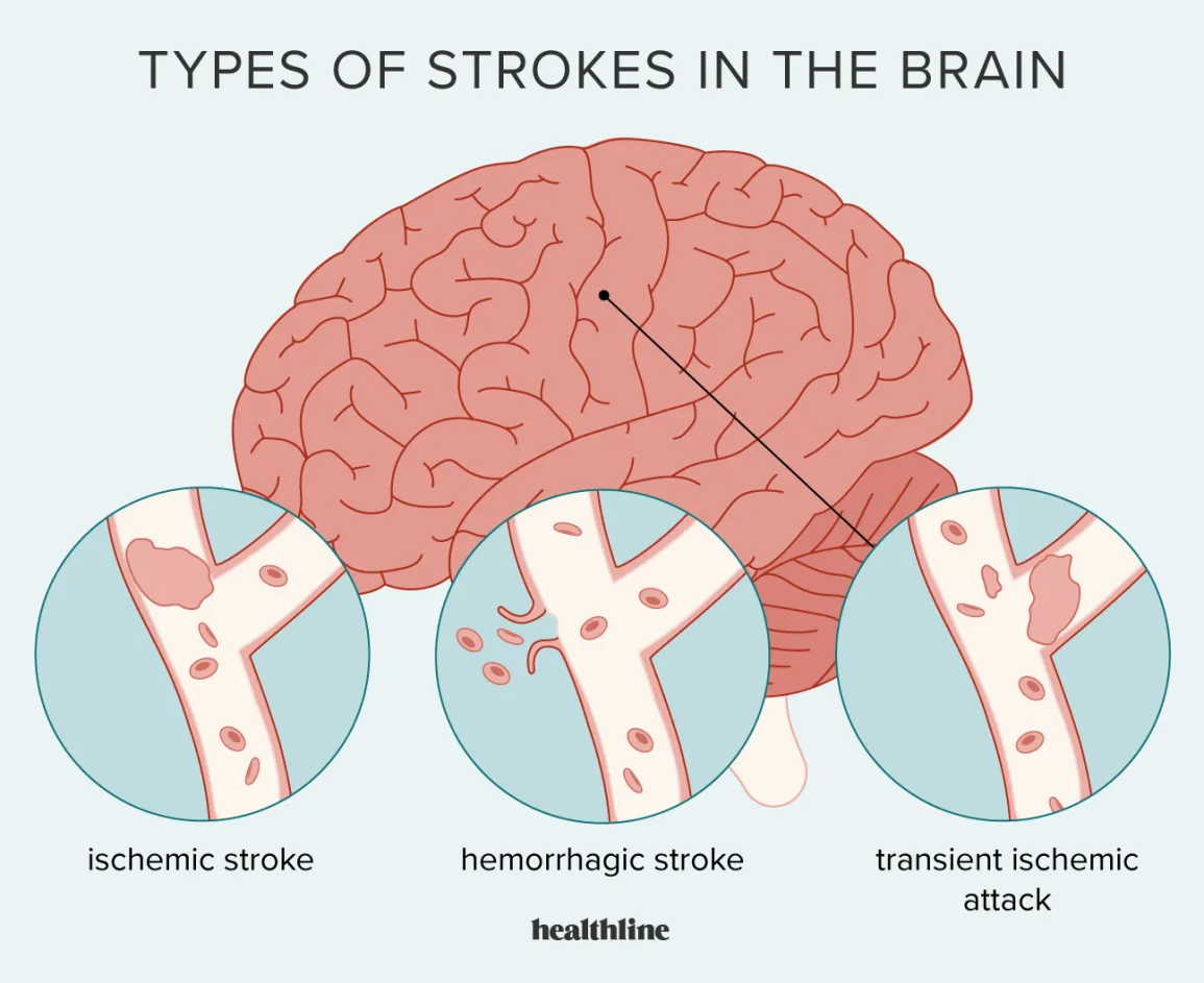 mild-stroke-10-mild-stroke-symptoms